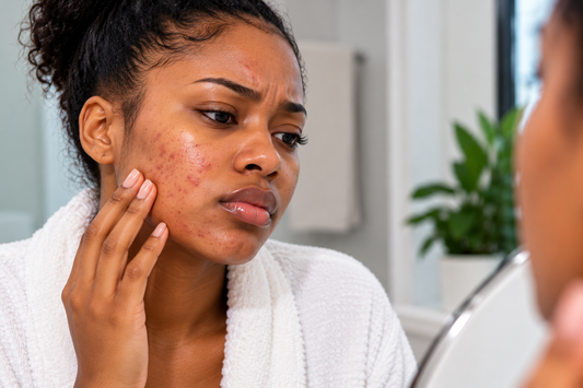 Why Does My Skin Keep Breaking Out? 5 Things Your Skin May Be Telling You